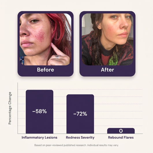 Azelaic Acid 14% Redness Reducing Cream