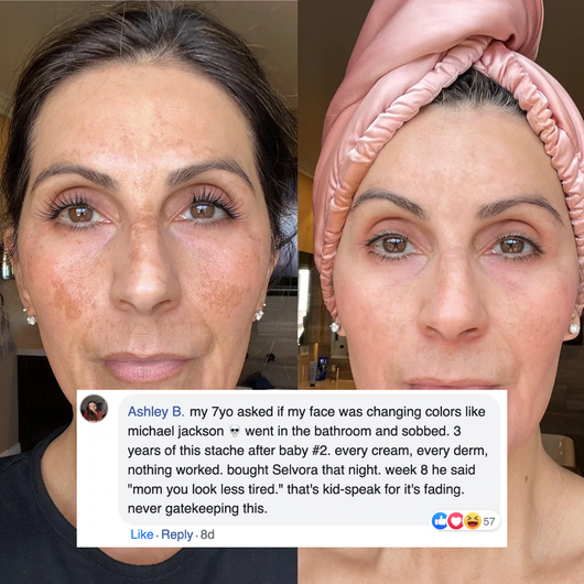 14% Azelaic Acid Melasma Correcting Cream