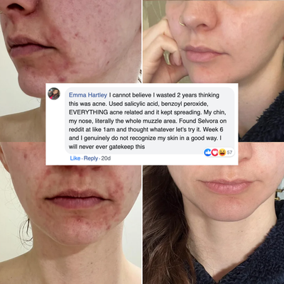 Azelaic Acid 14% POD Repair Cream