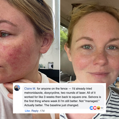 Azelaic Acid 14% Redness Reducing Cream