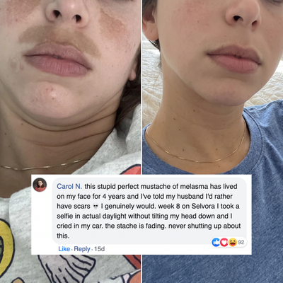 14% Azelaic Acid Melasma Correcting Cream