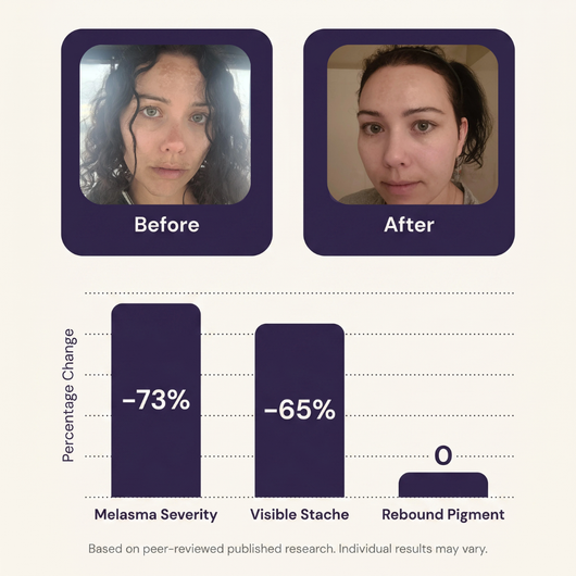14% Azelaic Acid Melasma Correcting Cream